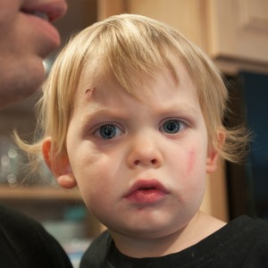 Community Gatepath recommends an ambulance for the bruise on Arlo's left cheek. The scrape on his forehead and cut on his lip are from other toddler moments. He had an unusually clumsy week.
